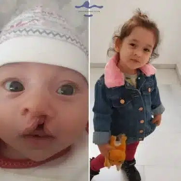 Расщелина губы и мягкого неба