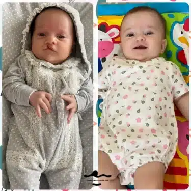 Расщелина губы и мягкого неба