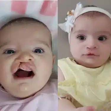 Расщелина губы и мягкого неба