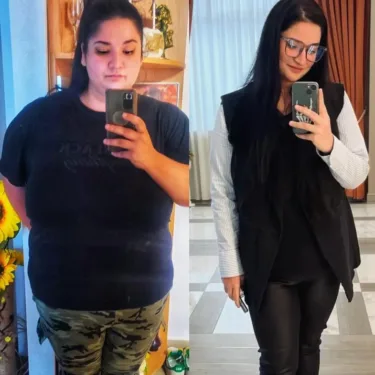 Bariatric surgery for weight loss