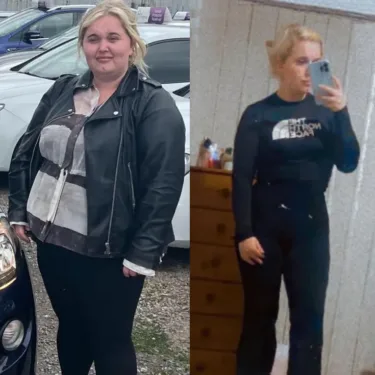 Bariatric surgery for weight loss