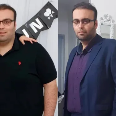 Bariatric surgery for weight loss