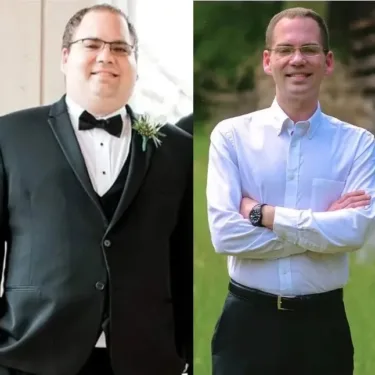 Bariatric surgery for weight loss