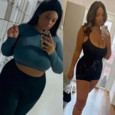 Bariatric surgery for weight loss