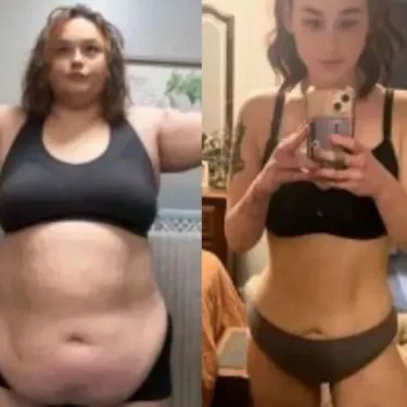 Bariatric surgery for weight loss