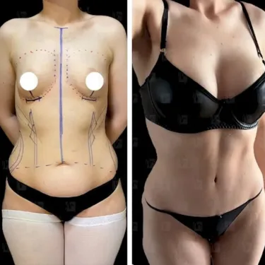 Breast surgery
