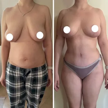 Breast surgery