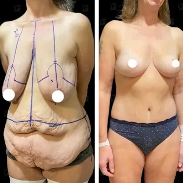 Breast surgery