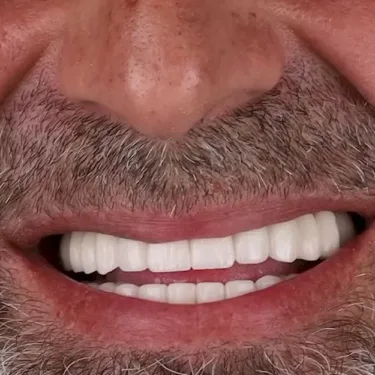 Голливудская улыбка