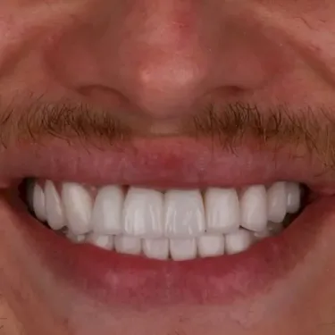 Голливудская улыбка