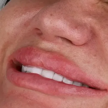 Голливудская улыбка