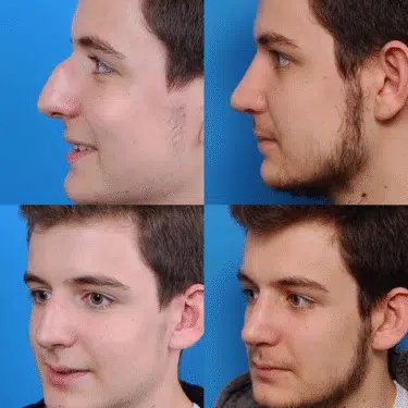 Ринопластика