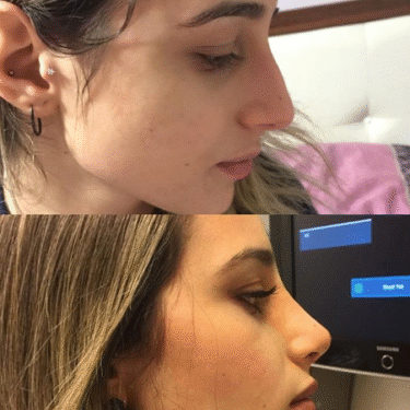 Ринопластика