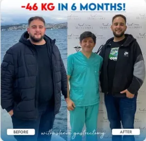 Рукавная резекция желудка в Турции у доктора Недждета Деричи