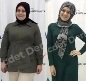 Рукавная резекция желудка в Турции у доктора Недждета Деричи