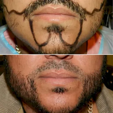 Beard transplant