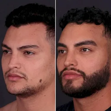 Beard transplant