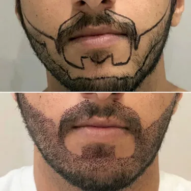 Beard transplant