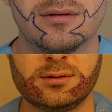 Beard transplant