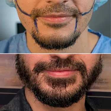 Beard transplant