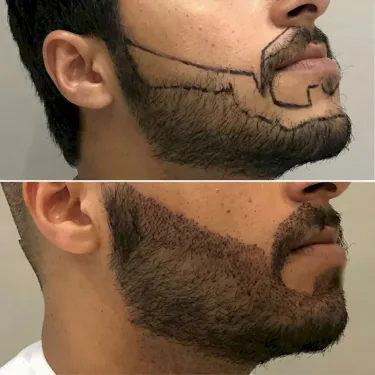 Beard transplant