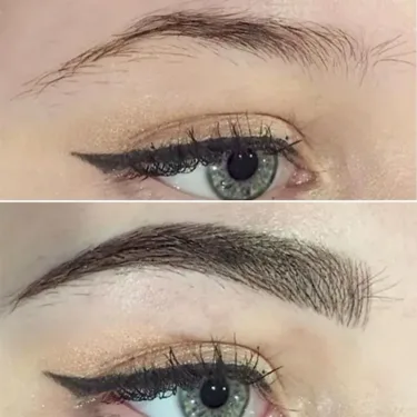 Eyebrow Transplantation