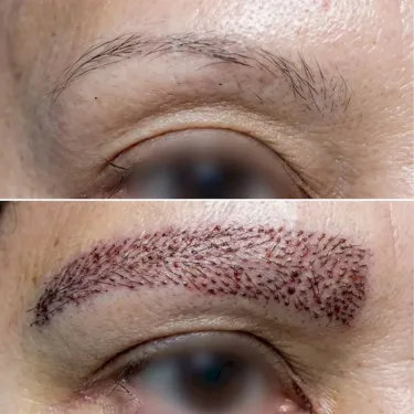 Eyebrow Transplantation