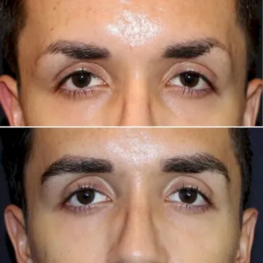 Eyebrow Transplantation