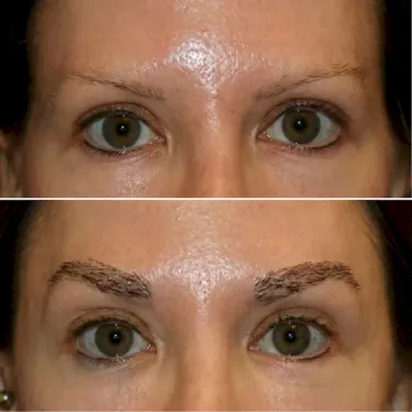 Eyebrow Transplantation