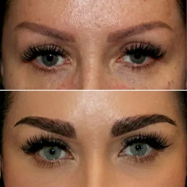 Eyebrow Transplantation