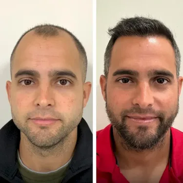 Hair transplant