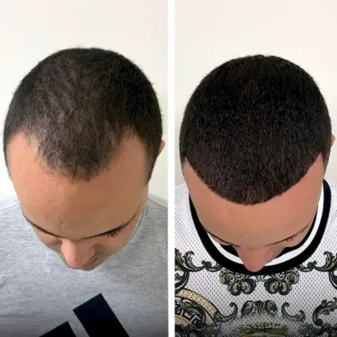 Hair transplant