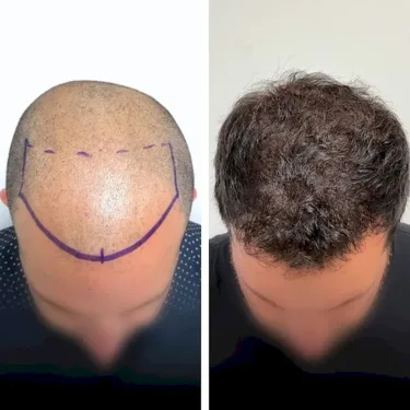 Hair transplant