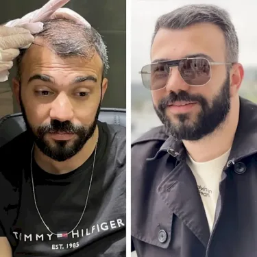 Hair transplant