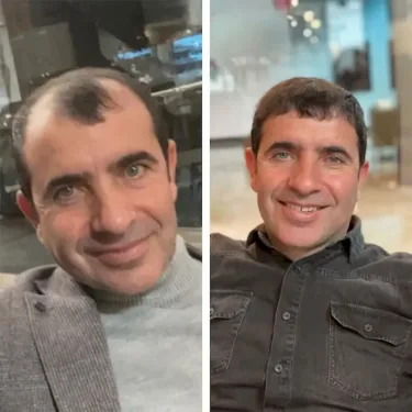 Hair transplant