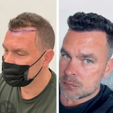 Hair transplant