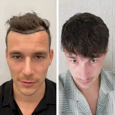 Hair transplant