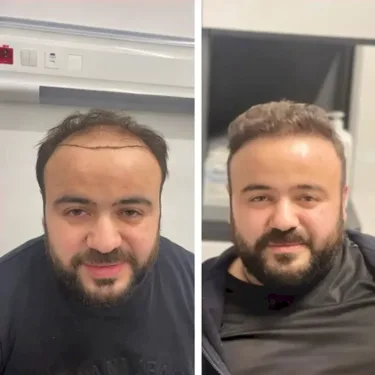 Трансплантация волос