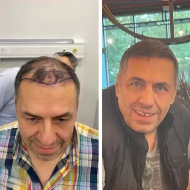 Hair transplant