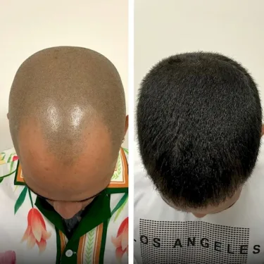 Hair transplant