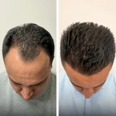 Hair transplant