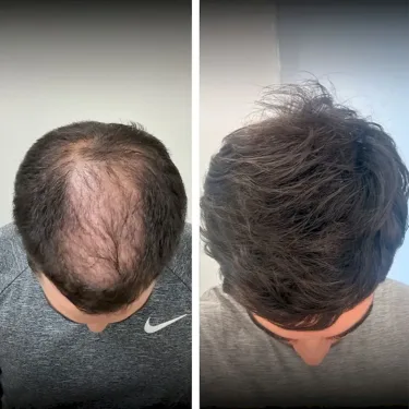Hair transplant