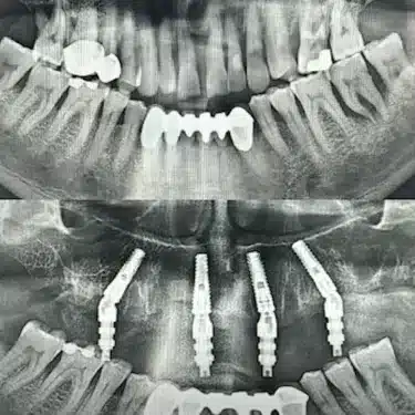 Dental Implants Using the All-on-4 and All-on-6 Systems