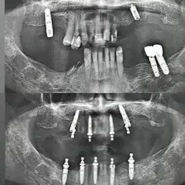 Dental Implants Using the All-on-4 and All-on-6 Systems