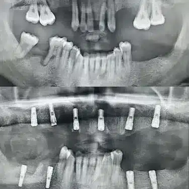 Dental Implants Using the All-on-4 and All-on-6 Systems