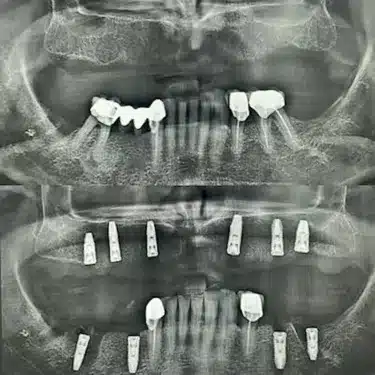 Dental Implants Using the All-on-4 and All-on-6 Systems