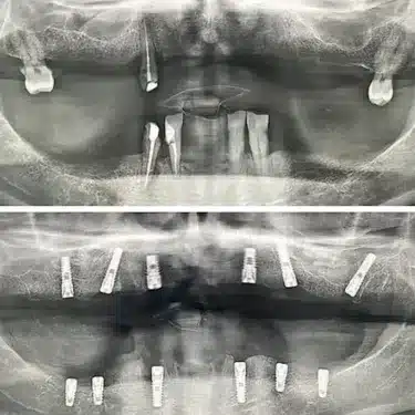 Dental Implants Using the All-on-4 and All-on-6 Systems