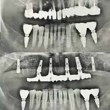 Dental Implants Using the All-on-4 and All-on-6 Systems