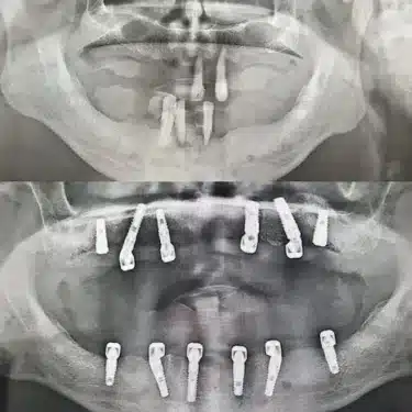 Dental Implants Using the All-on-4 and All-on-6 Systems