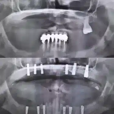 Dental Implants Using the All-on-4 and All-on-6 Systems